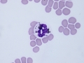 Neutrophil with melanin