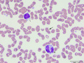 Lymphocyte & monocyte (DQ)