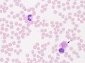 Neutrophil & lymphocyte