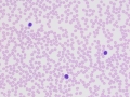 Leukemic phase of lymphoma