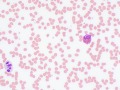 Dysplastic neutrophil