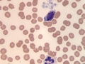 Neutrophil, reactive lymphocyte, platelet clump
