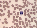 Pyknotic neutrophil
