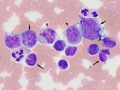 Mature lymphoid leukemia