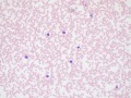 Mature lymphoid leukemia