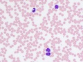 Mature lymphoid leukemia