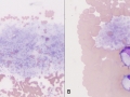Platelet clump