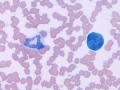 Toxic neutrophil & reactive lymphocyte