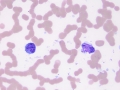 Suspect lymphoma of granular lymphocytes