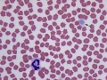 Thrombocytopenia