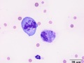 Lymphoma