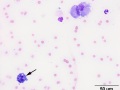 Lymphoma
