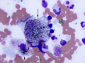 Melanoma