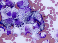 Melanoma