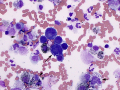 Melanoma