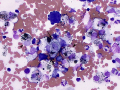 Melanoma