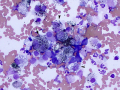 Melanoma
