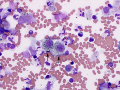 Melanoma