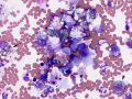 Melanoma