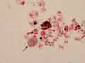 Melanoma (Prussian blue)