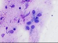 Chondroid-producing sarcoma