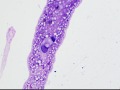 Chondroid-producing sarcoma