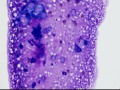 Chondroid-producing sarcoma