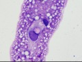 Chondroid-producing sarcoma
