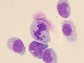 Lymphoma (aqueous)