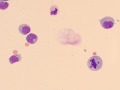 Lymphoma (aqueous)