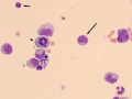 Lymphoma (aqueous)