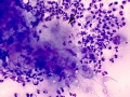 Corneal necrosis