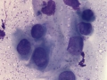 Crystalline keratopathy