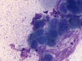 Crystalline keratopathy