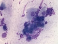 Crystalline keratopathy