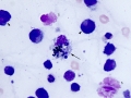 Lymphoma of granular lymphocytes (iris)