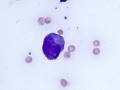 Lymphoma of granular lymphocytes (iris)