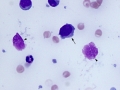 Lymphoma of granular lymphocytes