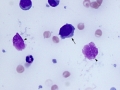 Lymphoma of granular lymphocytes (iris)