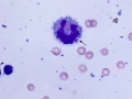 Lymphoma of granular lymphocytes (iris)