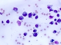 Lymphoma of granular lymphocytes (iris)