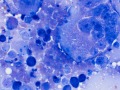 Tumor giant cell (carcinoma)