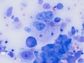 Tumor giant cell (carcinoma)