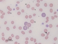 Regenerative anemia