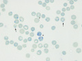 Heinz bodies, aggregate & punctate reticulocytes (NMB)