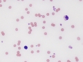 Pure red cell aplasia