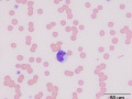 Granular lymphhocyte