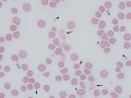 Oxidant-induced hemolysis