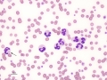 Neutrophil dysplasia (AML)