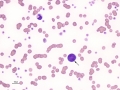 Presumptive proerythroblast (AML)